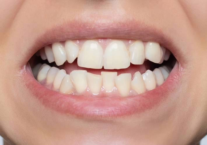 Crooked teeth before fitting WellaSmile
