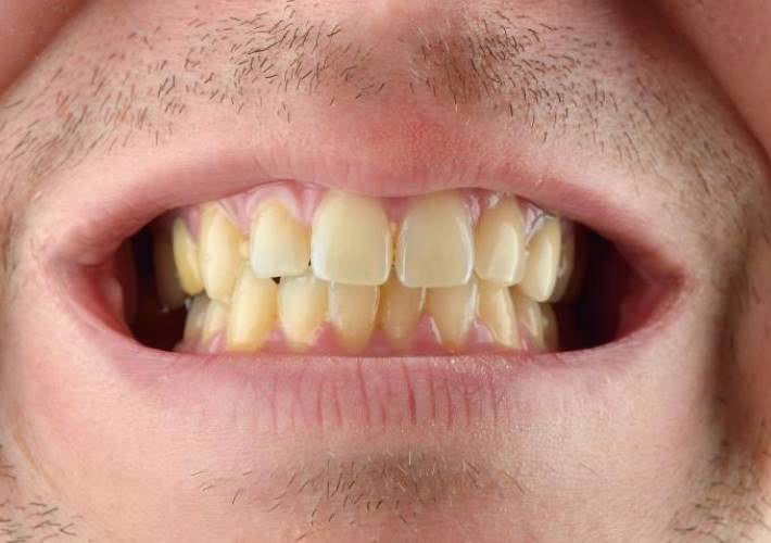 Yellowed teeth covered by a uniform WellaSmile white