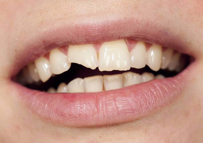 Chipped tooth smoothed over by WellaSmile