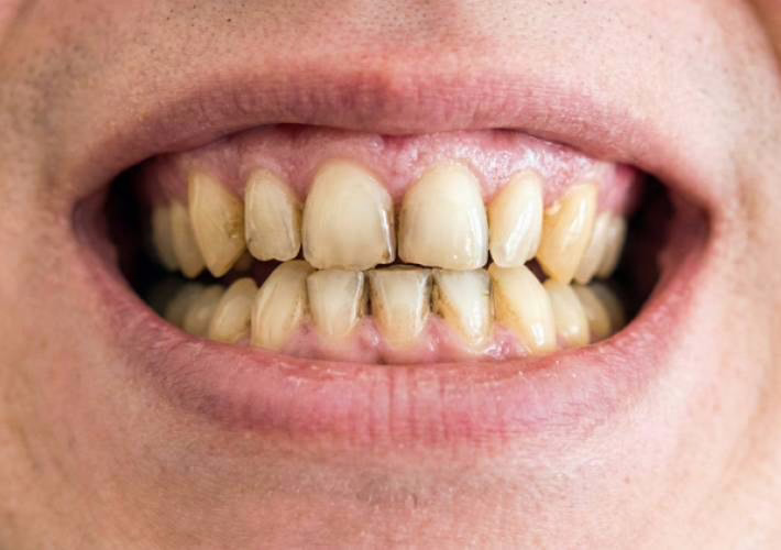 Dental stains covered by WellaSmile